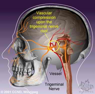 What is the standard treatment for neuralgia?